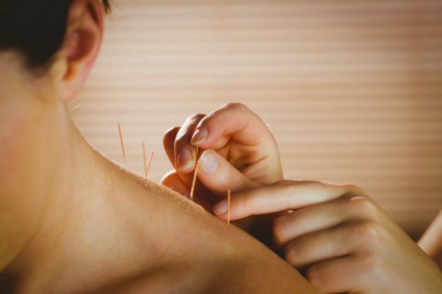 Cupping Therapy Insights